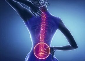 Manifestacije lumbalne osteohondroze